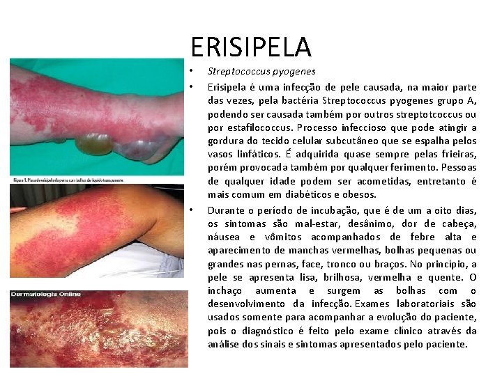 ERISIPELA • • • Streptococcus pyogenes Erisipela é uma infecção de pele causada, na