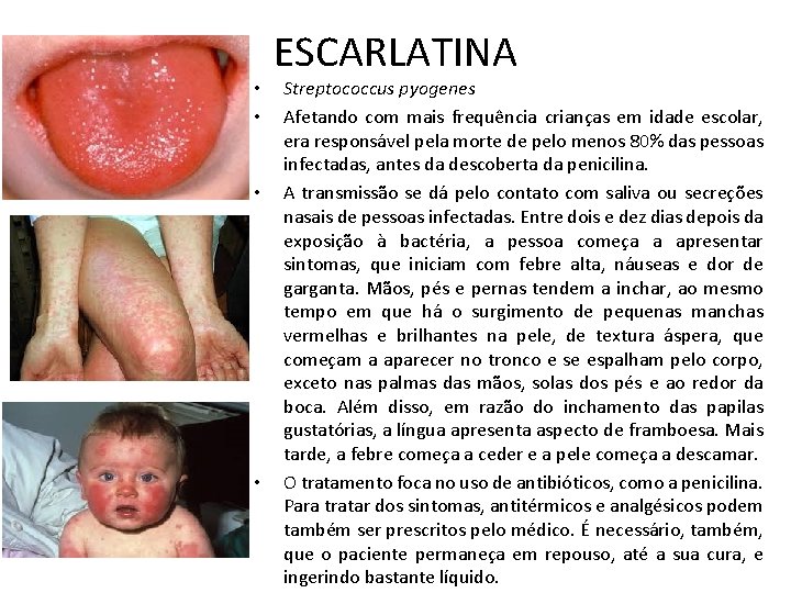  • • ESCARLATINA Streptococcus pyogenes Afetando com mais frequência crianças em idade escolar,