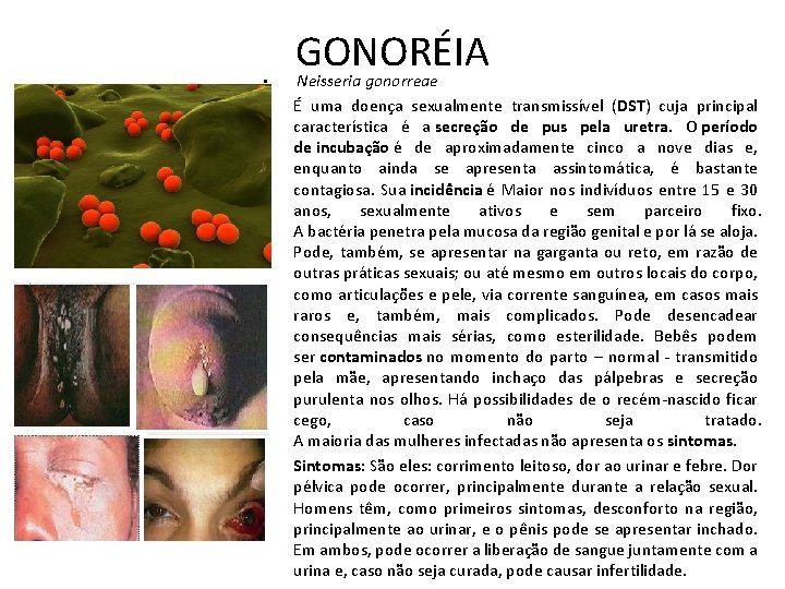  • • • GONORÉIA Neisseria gonorreae É uma doença sexualmente transmissível (DST) cuja