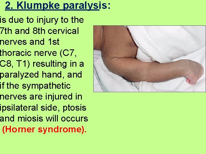 2. Klumpke paralysis: is due to injury to the 7 th and 8 th