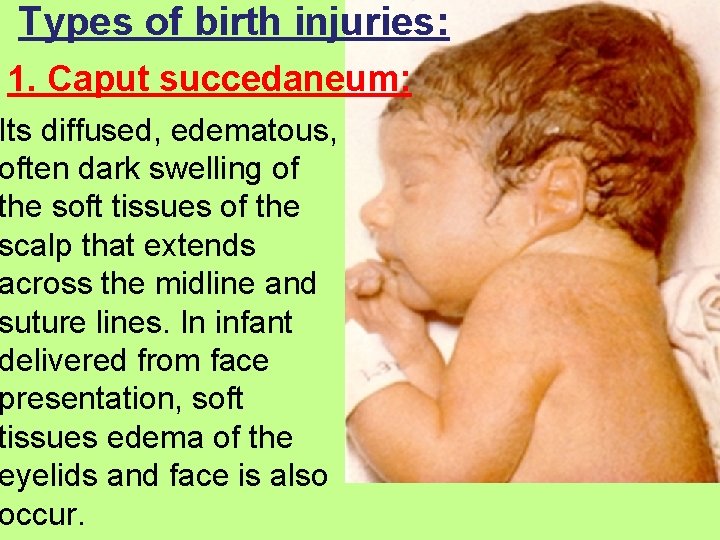 Types of birth injuries: 1. Caput succedaneum: Its diffused, edematous, often dark swelling of