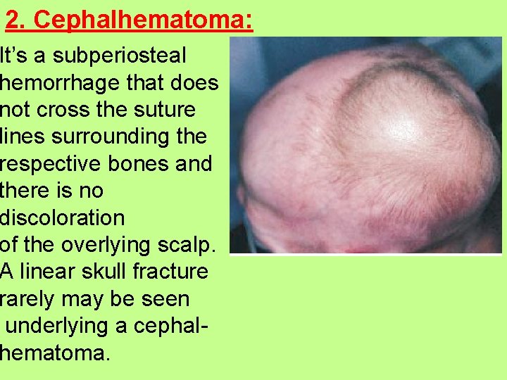 2. Cephalhematoma: It’s a subperiosteal hemorrhage that does not cross the suture lines surrounding