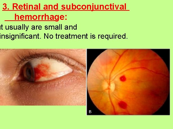 3. Retinal and subconjunctival hemorrhage: ut usually are small and insignificant. No treatment is