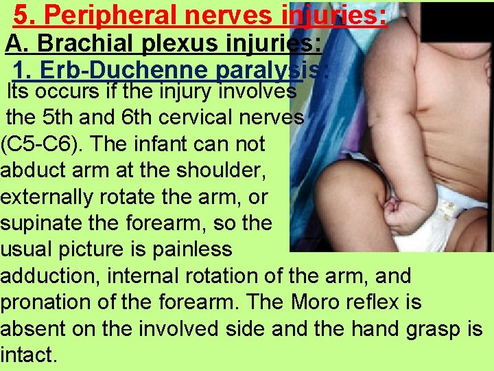 5. Peripheral nerves injuries: A. Brachial plexus injuries: 1. Erb-Duchenne paralysis: Its occurs if