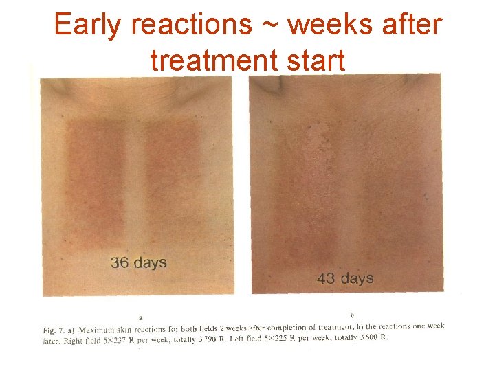 Early reactions ~ weeks after treatment start 