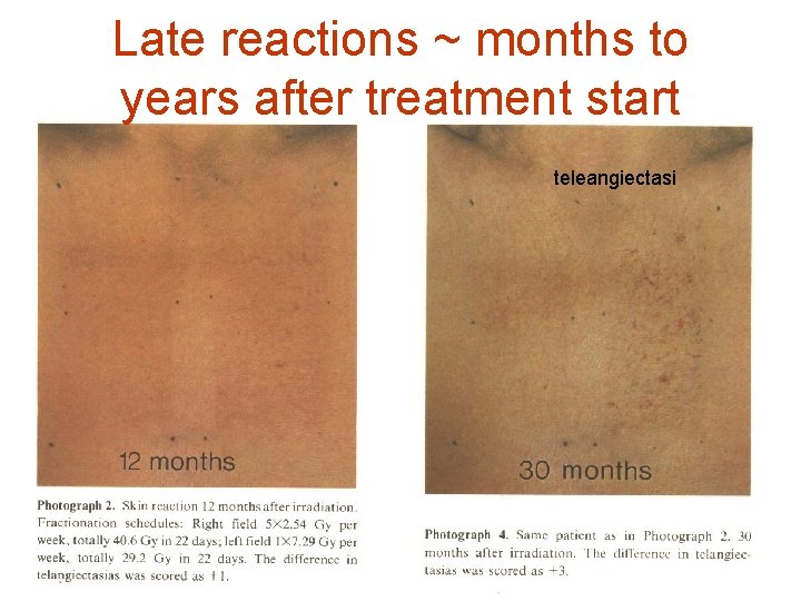 Late reactions ~ months to years after treatment start teleangiectasi 