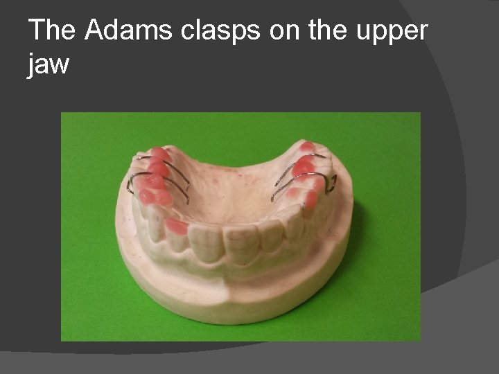 The Adams clasps on the upper jaw 