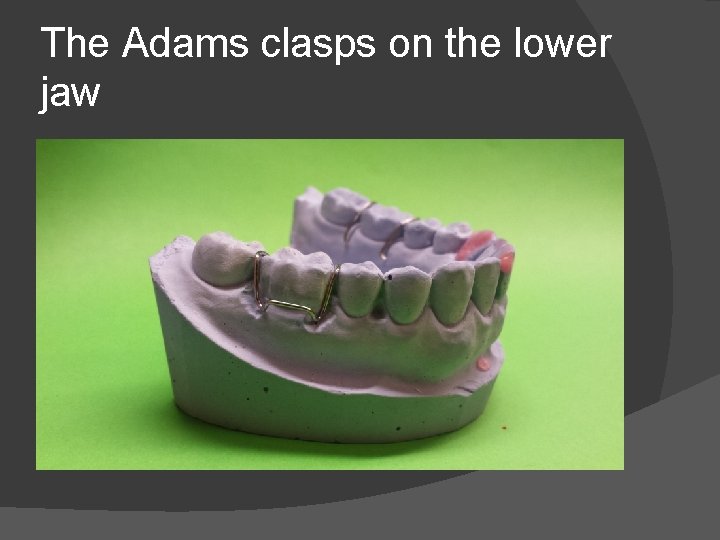 The Adams clasps on the lower jaw 