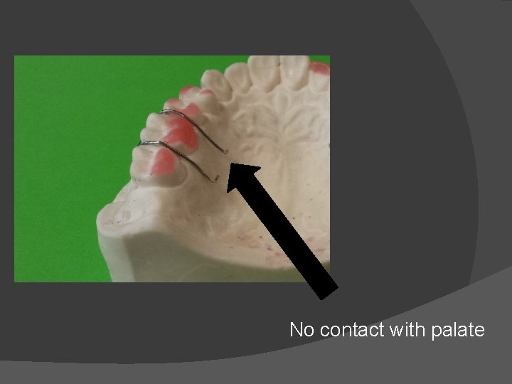 No contact with palate 