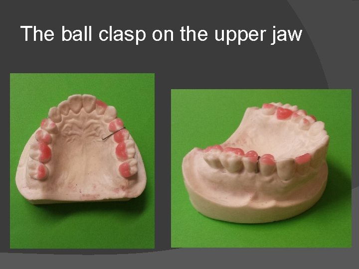 The ball clasp on the upper jaw 