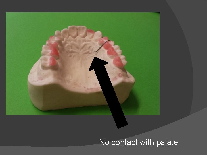 No contact with palate 