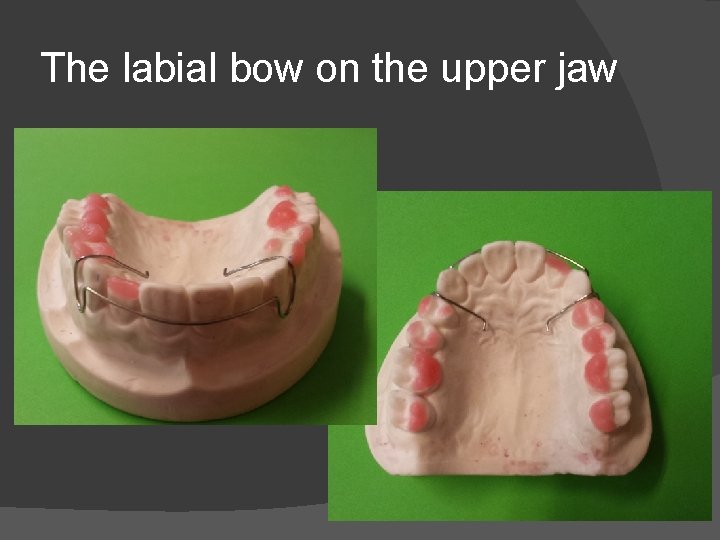 The labial bow on the upper jaw 