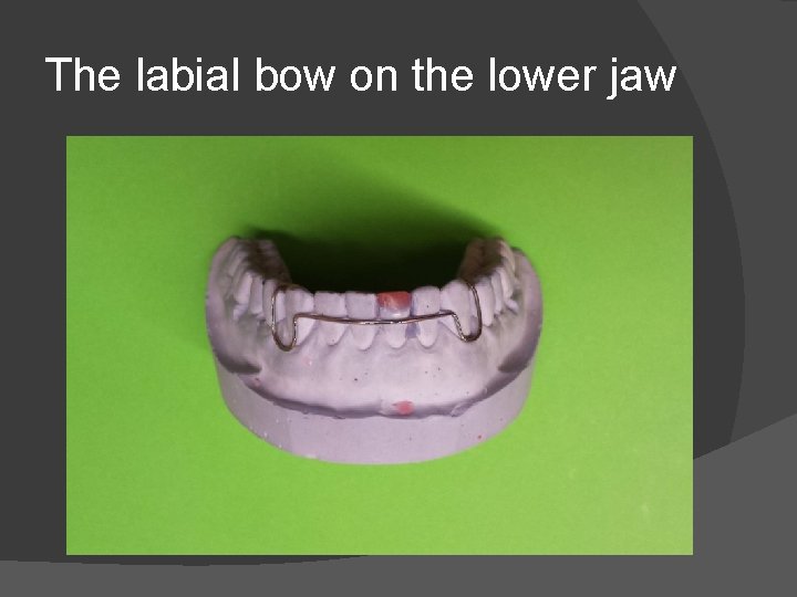 The labial bow on the lower jaw 
