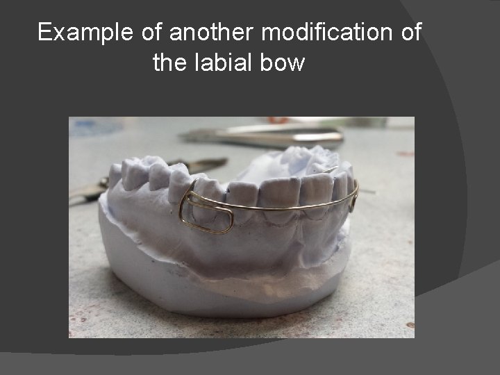 Example of another modification of the labial bow 