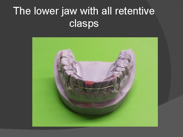 The lower jaw with all retentive clasps 