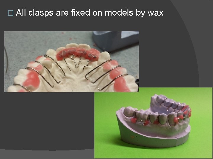 � All clasps are fixed on models by wax 