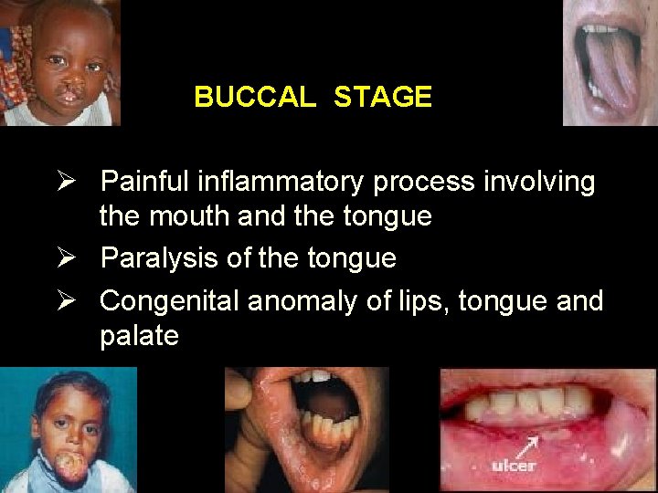 BUCCAL STAGE Ø Painful inflammatory process involving the mouth and the tongue Ø Paralysis