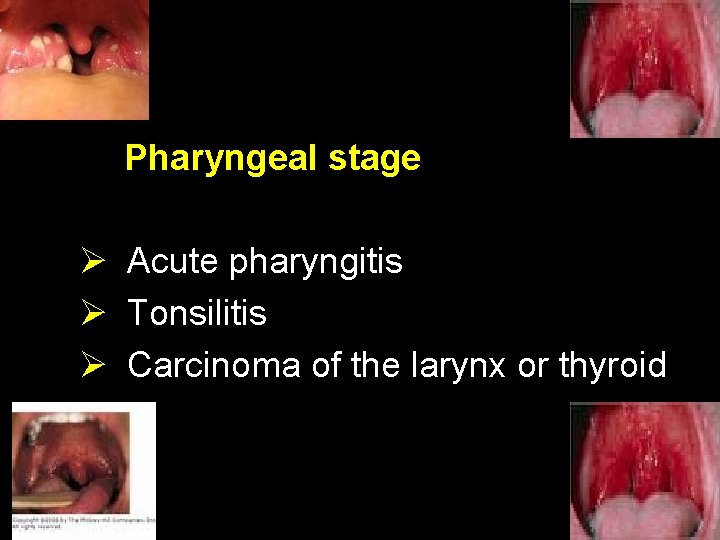 Pharyngeal stage Ø Acute pharyngitis Ø Tonsilitis Ø Carcinoma of the larynx or thyroid