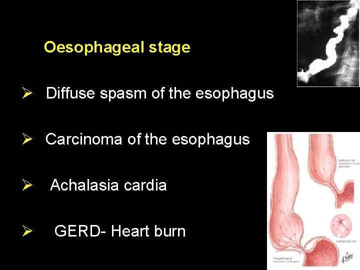 Oesophageal stage Ø Diffuse spasm of the esophagus Ø Carcinoma of the esophagus Ø