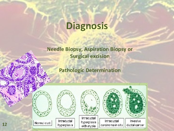 Diagnosis Needle Biopsy, Aspiration Biopsy or Surgical excision Pathologic Determination 12 