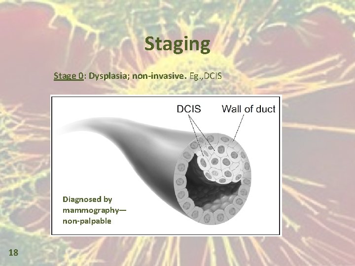 Staging Stage 0: Dysplasia; non-invasive. Eg. , DCIS Diagnosed by mammography— non-palpable 18 