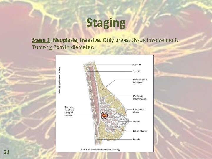 Staging Stage 1: Neoplasia; invasive. Only breast tissue involvement. Tumor < 2 cm in