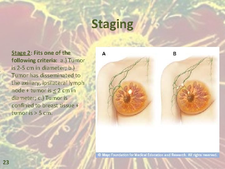 Staging Stage 2: Fits one of the following criteria: a. ) Tumor is 2