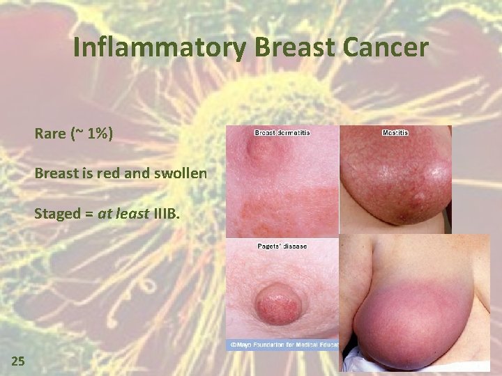 Inflammatory Breast Cancer Rare (~ 1%) Breast is red and swollen Staged = at