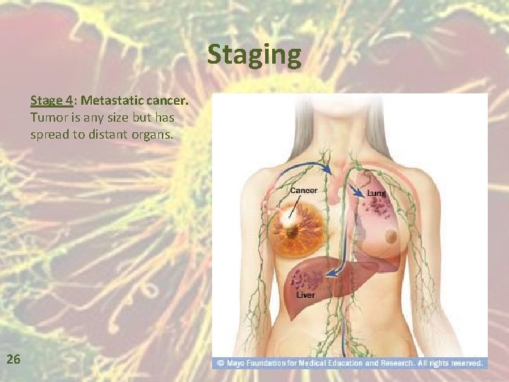 Staging Stage 4: Metastatic cancer. Tumor is any size but has spread to distant