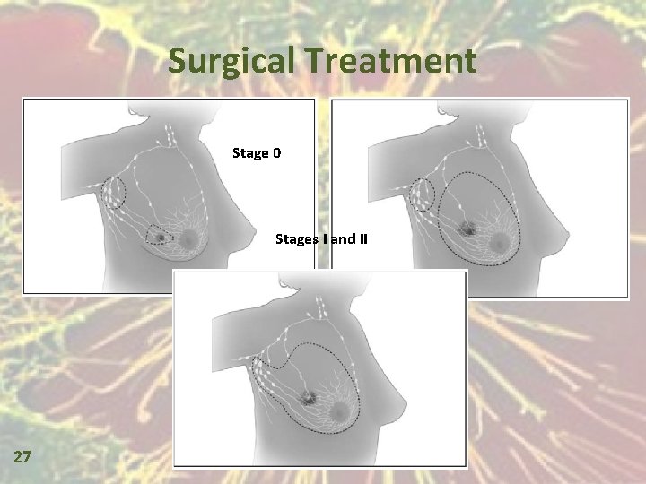 Surgical Treatment Stage 0 Stages I and II 27 