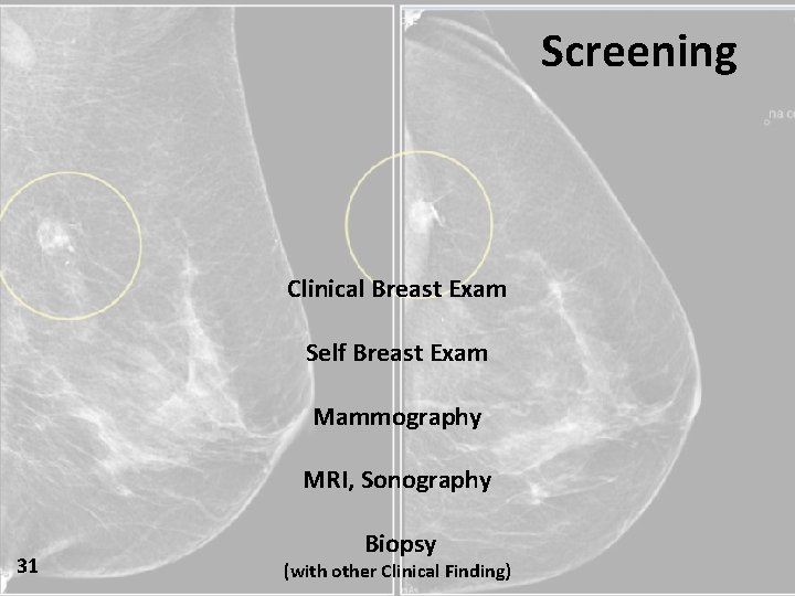 Screening Clinical Breast Exam Self Breast Exam Mammography MRI, Sonography 31 Biopsy (with other