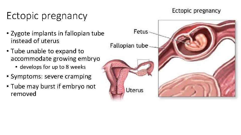 Ectopic pregnancy • Zygote implants in fallopian tube instead of uterus • Tube unable