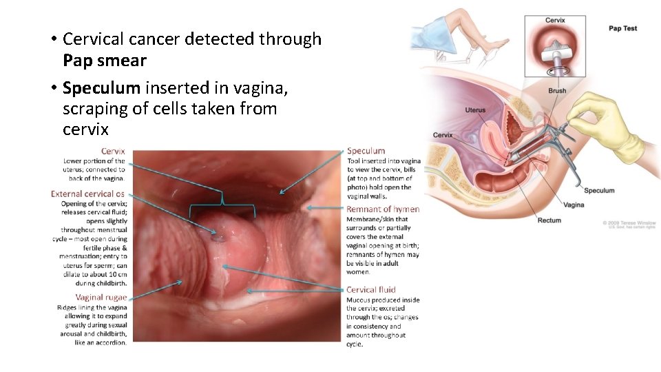  • Cervical cancer detected through Pap smear • Speculum inserted in vagina, scraping