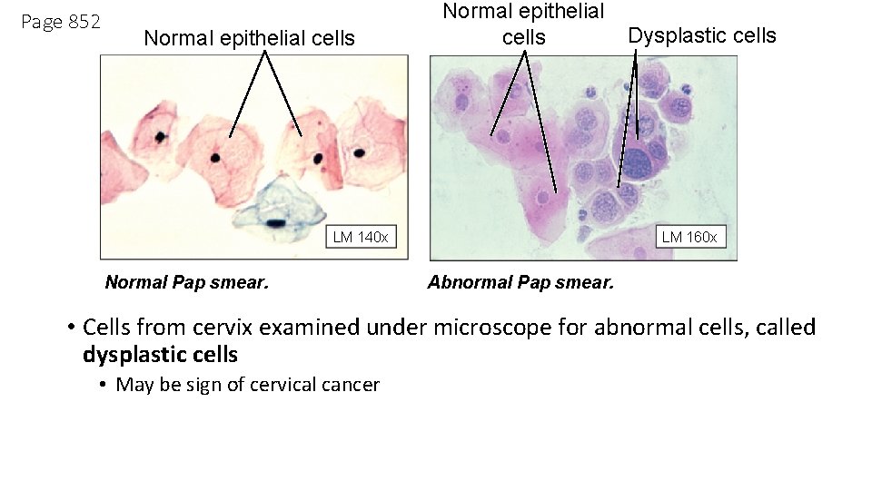 Page 852 Normal epithelial cells LM 140 x Normal Pap smear. Dysplastic cells LM Page 852 Normal epithelial cells LM 140 x Normal Pap smear. Dysplastic cells LM
