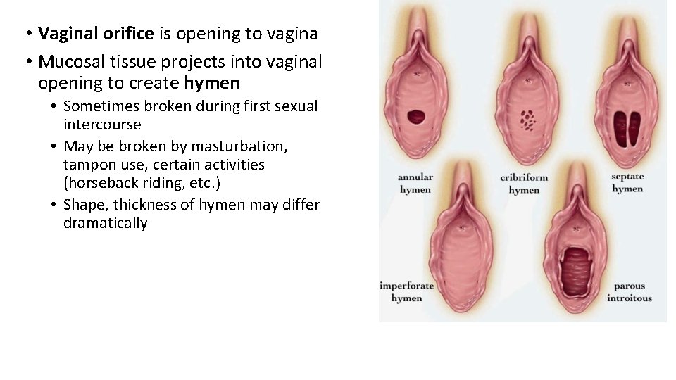  • Vaginal orifice is opening to vagina • Mucosal tissue projects into vaginal