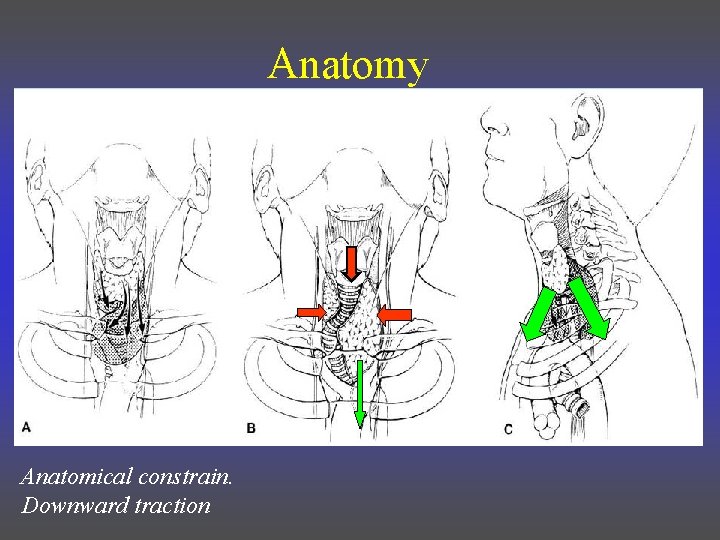 Anatomy Anatomical constrain. Downward traction 