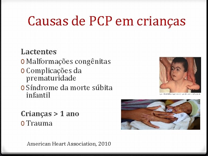 Causas de PCP em crianças Lactentes 0 Malformações congênitas 0 Complicações da prematuridade 0