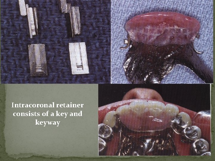Intracoronal retainer consists of a key and keyway Intracoronal retainer consists of a key and keyway