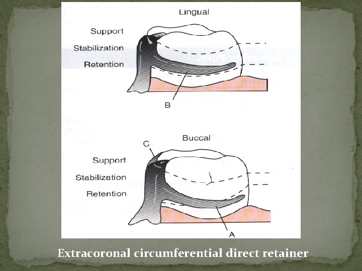 Extracoronal circumferential direct retainer 