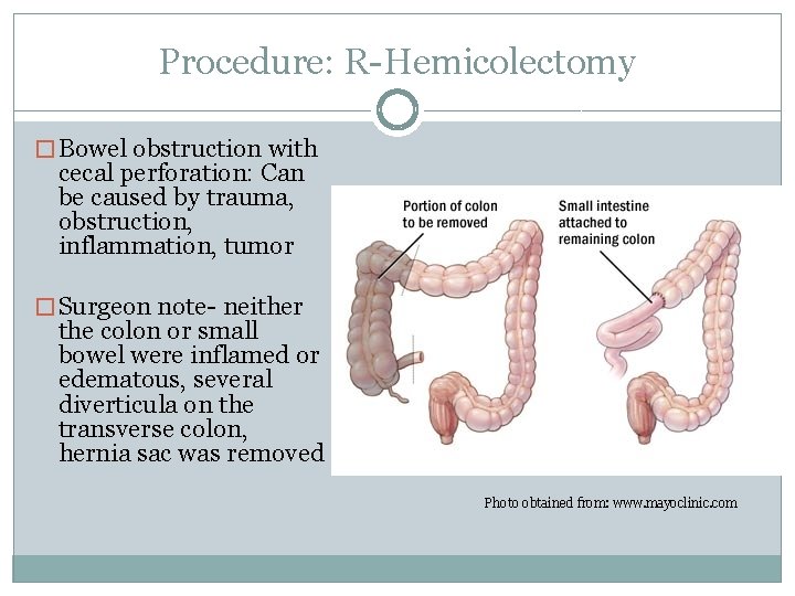 Procedure: R-Hemicolectomy � Bowel obstruction with cecal perforation: Can be caused by trauma, obstruction,