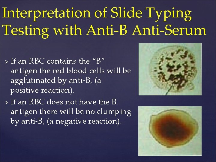 Interpretation of Slide Typing Testing with Anti-B Anti-Serum If an RBC contains the “B”