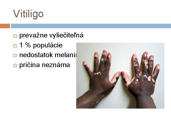 Vitiligo prevažne vyliečiteľná 1 % populácie nedostatok melanínu príčina neznáma 