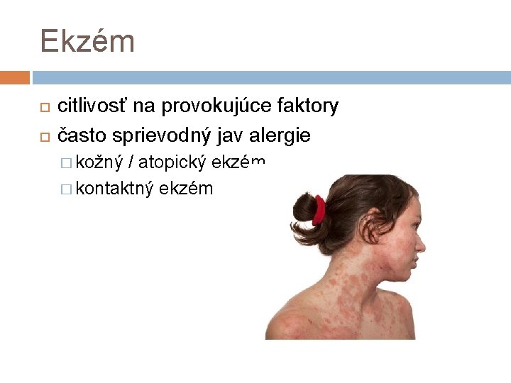 Ekzém citlivosť na provokujúce faktory často sprievodný jav alergie � kožný / atopický ekzém