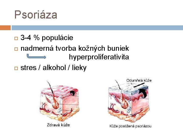 Psoriáza 3 -4 % populácie nadmerná tvorba kožných buniek hyperproliferativita stres / alkohol /