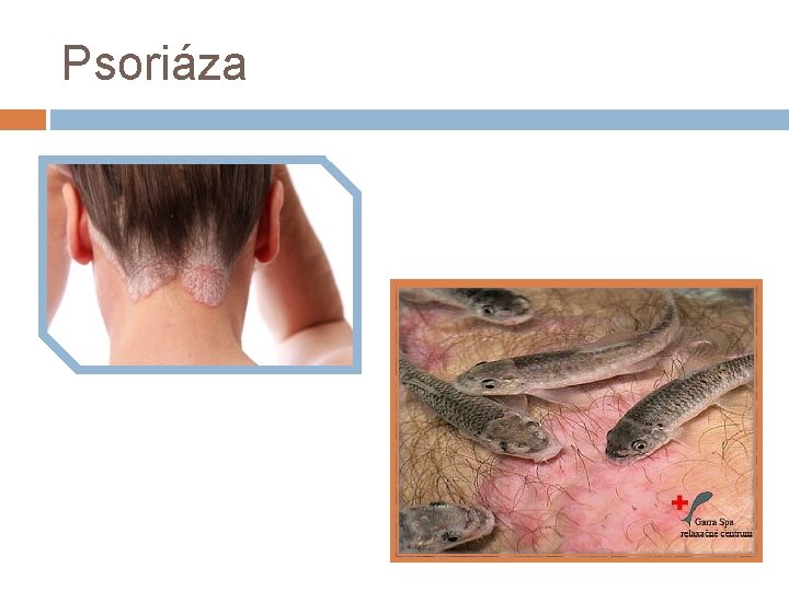 Psoriáza 