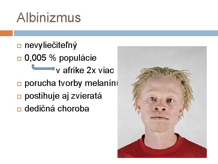 Albinizmus nevyliečiteľný 0, 005 % populácie v afrike 2 x viac porucha tvorby melanínu