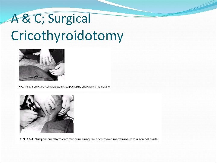 A & C; Surgical Cricothyroidotomy 