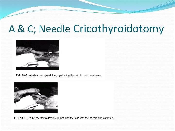 A & C; Needle Cricothyroidotomy 