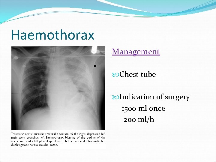 Haemothorax Management Chest tube Indication of surgery 1500 ml once 200 ml/h 