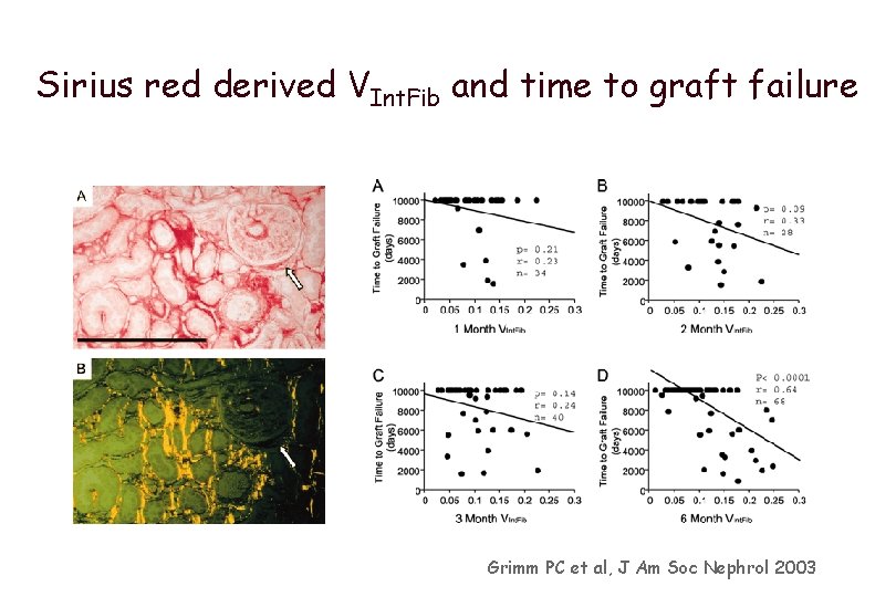 Sirius red derived VInt. Fib and time to graft failure Grimm PC et al,